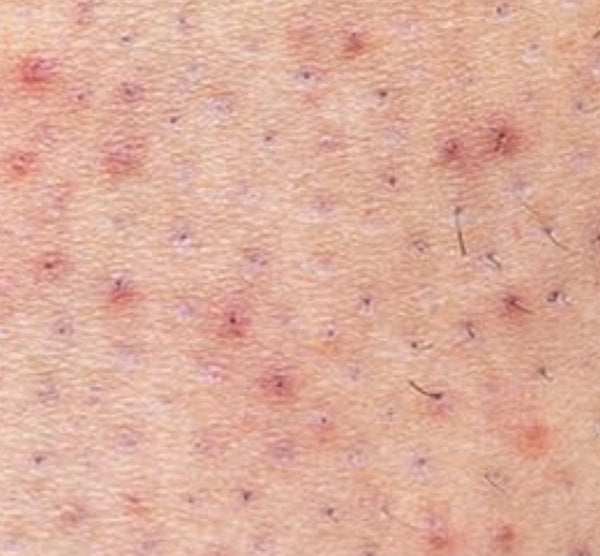 Razor Burn