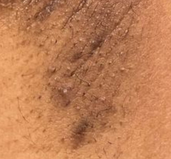 Dark Spots